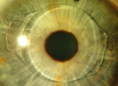 μάτι-τρόποι διόρθωσης των διαθλαστικών σφαλμάτων