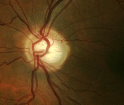 Οπτικό νεύρο με μεγάλη βλάβη Οπτικό νεύρο με μεγάλη βλάβη