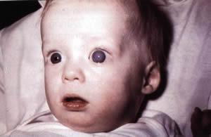 Συγγενές Γλαύκωμα Συγγενές Γλαύκωμα